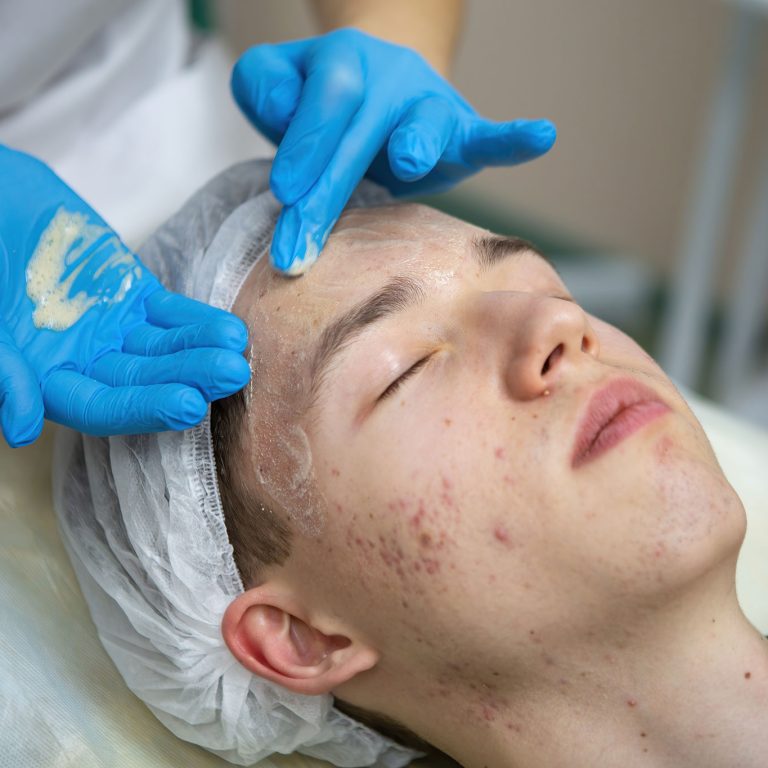 acne-treatment